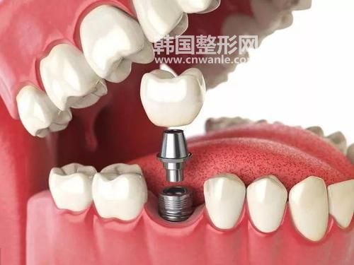 種植牙后要注意什么