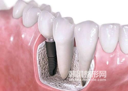 <a href='/tag_zhongzhiya27.html'>種植牙</a>一顆多少錢？