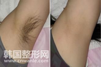 冰點(diǎn)<a href='/tag_tuomao16.html'>脫毛</a>脫腋毛疼嗎 皮膚黑會(huì)很疼對(duì)嗎?