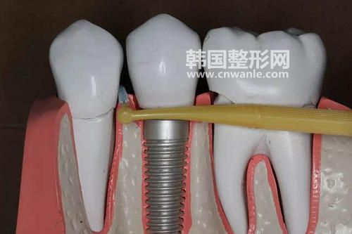 <a href='/tag_zhongzhiyashouming.html'>種植牙壽命</a>多少年