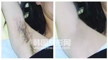 冰點<a href='/tag_tuomao16.html'>脫毛</a>