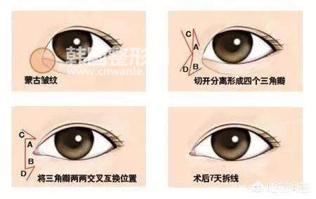 為什么有些人不建議<a href='/tag_kaiyanjiao68.html'>開眼角</a>