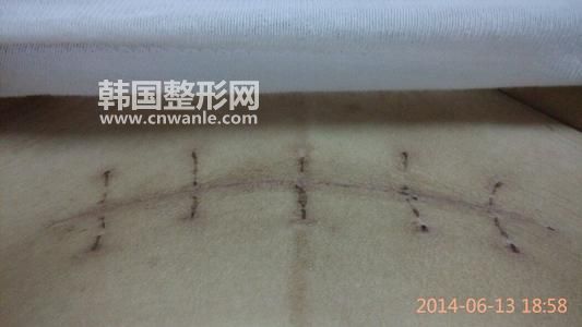 <a href='/tag_bahen21.html'>疤痕</a>增生