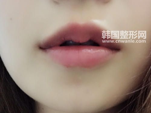 豐唇術(shù)后怎樣保養(yǎng)