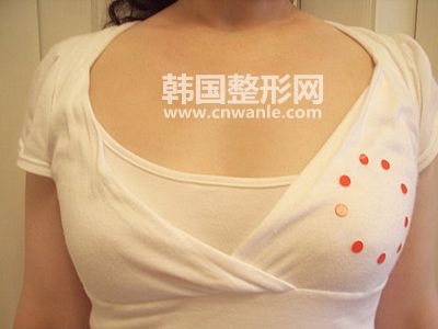 <a href='/tag_jiati95.html'>假體</a>豐胸有什么副作用？
