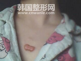 <a href='/tag_bahengedazhi.html'>疤痕疙瘩治療</a>需要多少錢？
