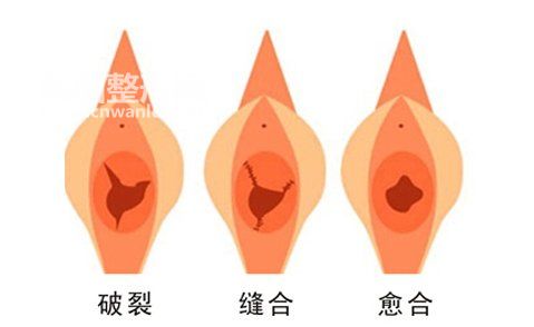 <a href='/tag_chunvmo16.html'>處女膜</a>修復(fù)術(shù)是怎樣的