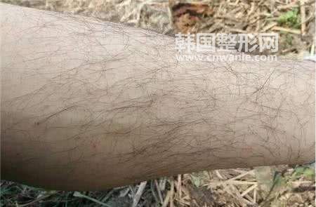 　　無論男女身體上長出一些多余的體毛這是很正常的現(xiàn)象，一般來說，男性朋友們的體毛要比女性朋友們的多一些。由于激素分泌男性朋友們體毛旺盛一點，留個胡子，比較符合男性朋友們的氣質(zhì)，這樣子顯得有男人味兒。但是女性朋友們體毛多一點，就有點不好看雅觀了，這樣就需要做<a href='/tag_tuomaoshoushu2.html'>脫毛手術(shù)</a>了，隨著科技的發(fā)展，脫毛也不需要用刮胡刀剃毛了，在這里我給大家介紹一種新的無痛脫毛技術(shù)。 　　無痛脫毛有什么優(yōu)勢？ 　　一、獨創(chuàng)技術(shù)，真正無痛。冰點無痛脫毛激光是第三代的脫毛激光產(chǎn)品，全新的雙脈沖模式保證了在加熱破壞毛囊的同時不會產(chǎn)生熱損傷，不會出現(xiàn)過熱反應，整個過程可以在幾乎無痛的狀態(tài)下進行。脫毛再也沒有什么痛苦可言，真正無痛脫毛，讓女性朋友們告別體毛煩惱。 　　二、冰點舒適，冰爽體驗。冰點無痛脫毛激光只要將毛囊周圍組織加熱到四十攝氏度，毛囊溫度升高到四十五攝氏度后持續(xù)很短的時間即可脫除毛發(fā)，在這個過程中由于優(yōu)良的冷卻技術(shù)，激光寶石窗口的溫度保持在四攝氏度左右，而表皮的溫度始終被控制在二十五攝氏度，所以我們感受到的只有陣陣舒適，涼爽舒適，讓脫毛不再是痛苦，成為一種享受。 　　三、安全高效，肌膚光潔動人。冰點無痛脫毛激光采用標準的脫毛波長，可以保證高效的毛發(fā)脫除，這種脫毛方法經(jīng)過，已經(jīng)成為美麗達人的首選，可以使肌膚更加光潔動人，真正零痛苦，零風險，高效率。