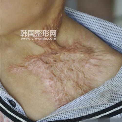 萎縮性<a href='/tag_bahenzhiliao.html'>疤痕治療</a>方法