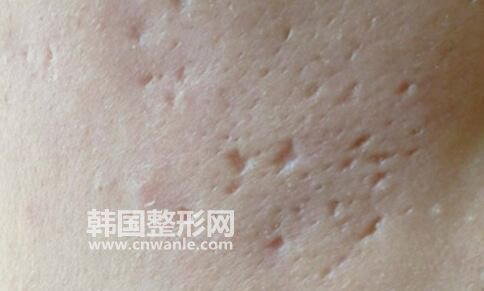 凹陷性<a href='/tag_bahen21.html'>疤痕</a>的分類(lèi)到底有幾種