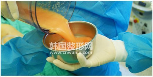 <a href='/tag_xiaotui26.html'>小腿</a><a href='/tag_xizhi74.html'>吸脂</a>術(shù)<a href='/tag_shouxiaotui8.html'>瘦小腿</a>有哪些注意事項？