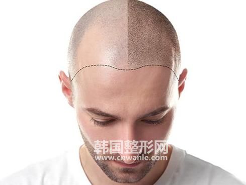 <a href='/tag_maofayizhi6.html'>毛發(fā)移植</a>術(shù)對(duì)身體有什么危害？