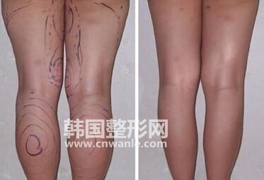 小腿<a href='/tag_xizhijianfei25.html'>吸脂減肥</a>術(shù)后皮膚為什么會(huì)變硬？