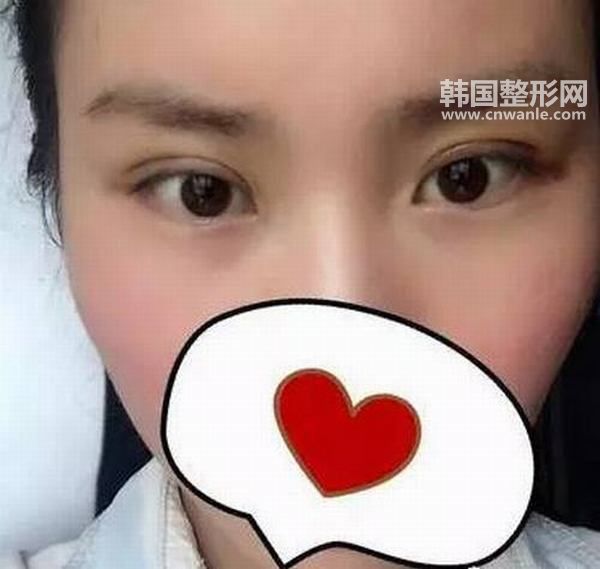 <a href='/tag_hanshisandian8.html'>韓式三點</a>無痛<a href='/tag_shuangyan108.html'>雙眼</a>皮效果怎么樣？
