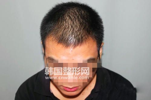 <a href='/tag_maofayizhi6.html'>毛發(fā)移植</a>手術(shù)后為什么要經(jīng)歷脫落期，以后還會掉嗎？
