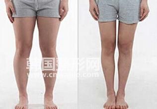選擇做<a href='/tag_datuixizhi10.html'>大腿吸脂</a><a href='/tag_jianfeishoushu.html'>減肥手術(shù)</a>效果怎么樣？