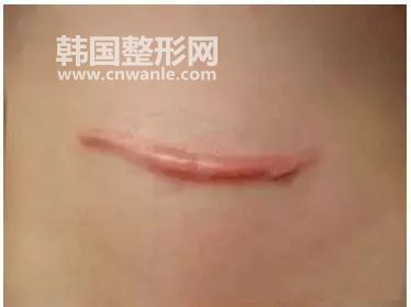 修復(fù)手術(shù)<a href='/tag_bahen21.html'>疤痕</a>的方法?