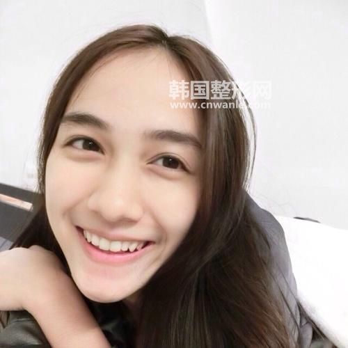 現(xiàn)在割<a href='/tag_shuangyanpidejia.html'>雙眼皮的價(jià)格</a>是多少錢？