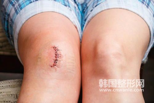 修復(fù)手術(shù)<a href='/tag_bahen21.html'>疤痕</a>的藥膏？