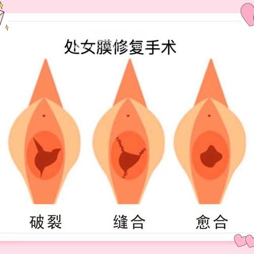 韓國微創(chuàng)整形<a href='/tag_chunvmo16.html'>處女膜</a>修復(fù)術(shù)讓女人更自信