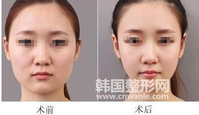 面部<a href='/tag_xizhi74.html'>吸脂</a>后遺癥有哪些？