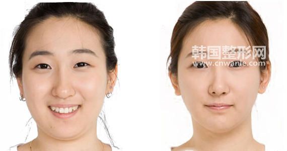 面部<a href='/tag_xizhi74.html'>吸脂</a>