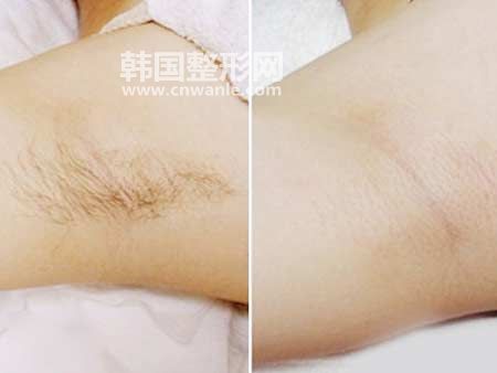 冰點(diǎn)<a href='/tag_tuomao16.html'>脫毛</a>的優(yōu)勢和好處有哪些？