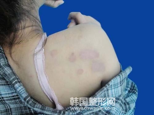 疤痕疙瘩最好治療修復(fù)方法?
