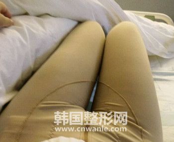 抽脂一定要穿塑身褲嗎?