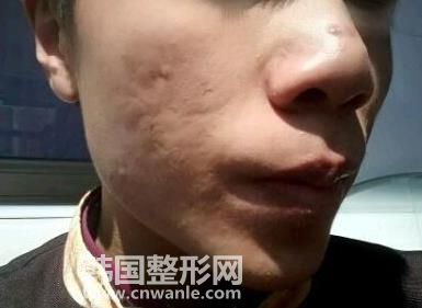 目前做微針<a href='/tag_zhidou3.html'>治痘</a>坑多少錢(qián)一次？