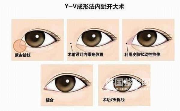 如何選擇開眼角方式？<a href='/tag_kaiyanjiaoduoshao.html'>開眼角多少錢</a>？