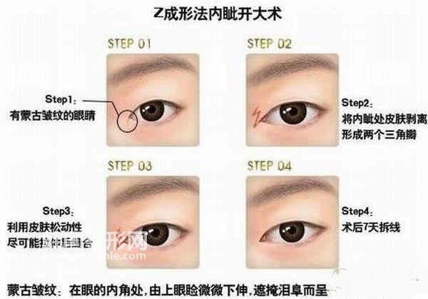 如何選擇開眼角方式？開<a href='/tag_yanjiaoduoshaoqian.html'>眼角多少錢</a>？