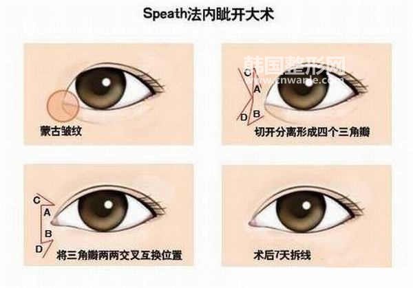 如何選擇開眼角方式？多少錢？