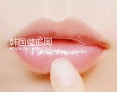唇珠成型術(shù)恢復(fù)后會變沒嗎?