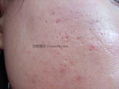 點陣激光祛<a href='/tag_douyin2.html'>痘印</a>有什么效果優(yōu)勢？