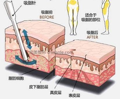 <a href='/tag_xizhi74.html'>吸脂</a>手術的危害和后遺癥