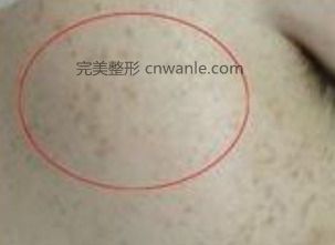 <a href='/tag_huangheban58.html'>黃褐斑</a>出現(xiàn)的原因是什么引起的?