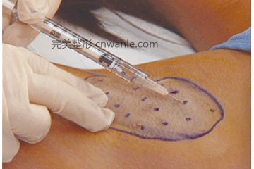 botox除<a href='/tag_yechou4.html'>腋臭</a>效果怎么樣？