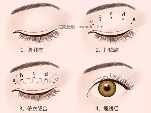 北京割<a href='/tag_shuangyan108.html'>雙眼</a>皮一般價(jià)格多少錢？