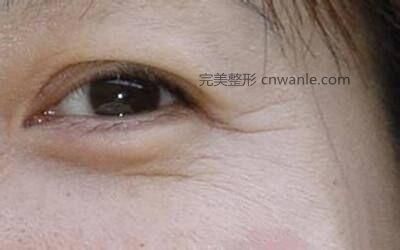 激光<a href='/tag_chuzhou14.html'>除皺</a>可以去除眼角皺紋嗎？