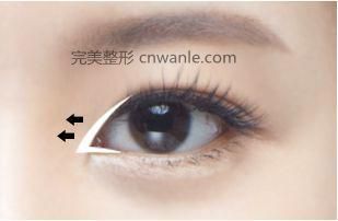 <a href='/tag_kaiyanjiao68.html'>開眼角</a>幾天<a href='/tag_chaixian.html'>拆線</a>最好？疼不疼