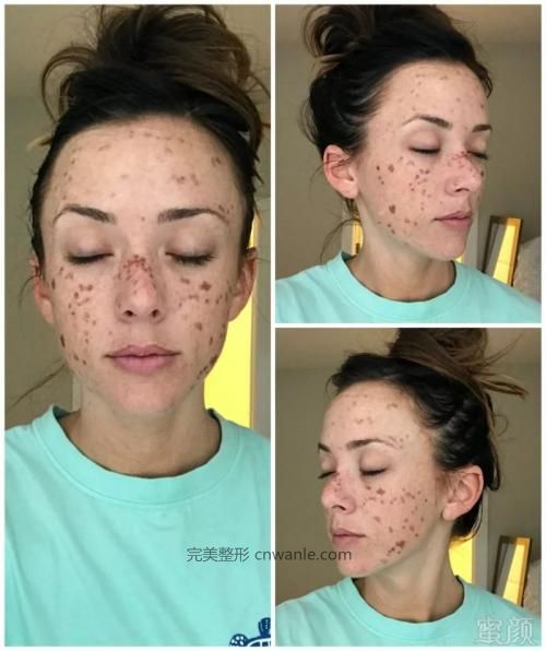 激光怎么祛老年斑的原理？