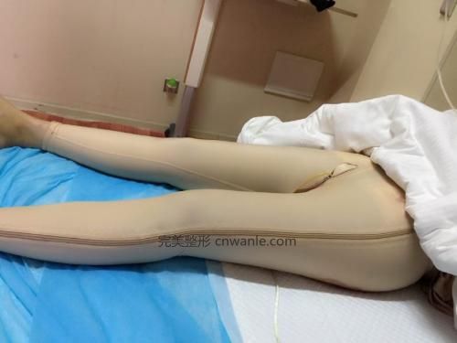 劉存琳<a href='/tag_datui21.html'>大腿</a><a href='/tag_xizhi74.html'>吸脂</a>反彈嗎?