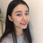敏敏玻尿酸豐面頰術后14天 圖2