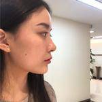 敏敏玻尿酸豐面頰術后14天 圖4