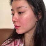 敏敏玻尿酸豐面頰術后150天 圖1
