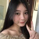 敏敏玻尿酸豐面頰術后138天 圖1