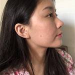 敏敏玻尿酸豐面頰術后91天 圖2