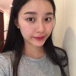敏敏玻尿酸豐面頰術后28天 圖1