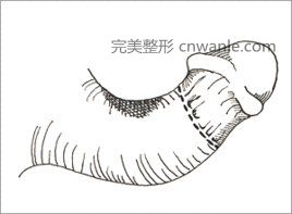 <a href='/tag_yinjingzengcu.html'>陰莖增粗</a>術(shù)是什么？適合哪些人群？